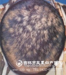 梅毒性脱发:约占病人的10%