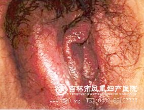 千庭大腺炎网-吉林市凤凰妇产科医院-吉林好