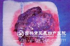 葡萄胎