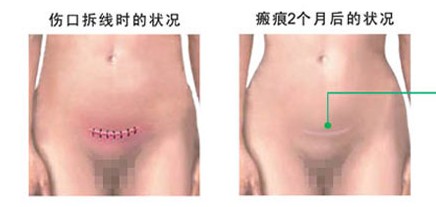 剖腹产