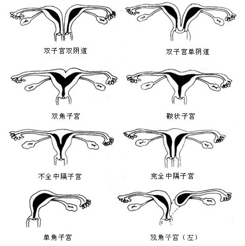 子宫发育不良  又称幼稚子宫,系副中肾管会合后短时期内即停止发育